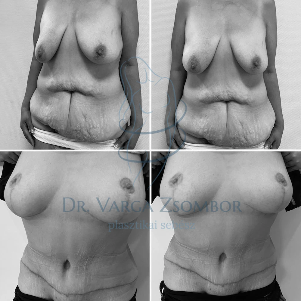 Teljes átalakulás (kombinált has- és mellplasztika, zsírleszívással)