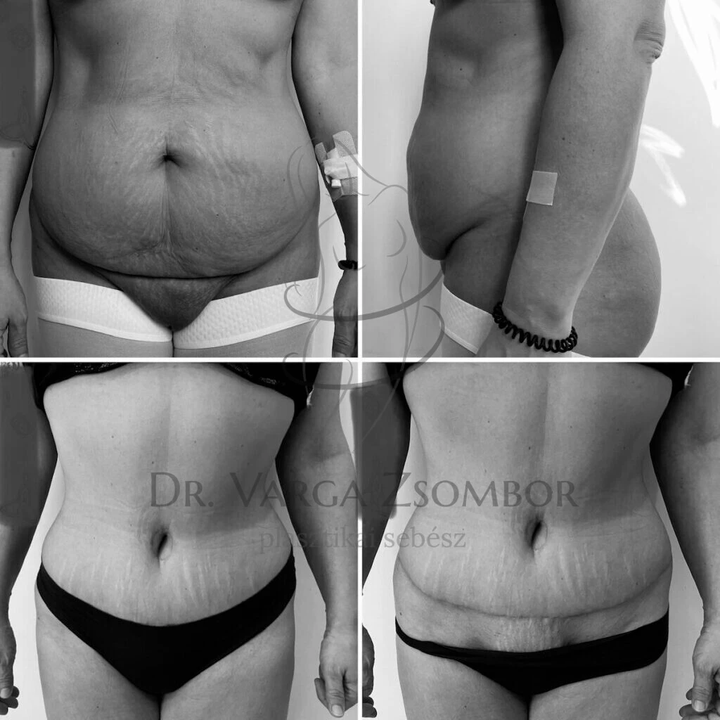 Teljes hasplasztika hege a fehérnemű takarásában