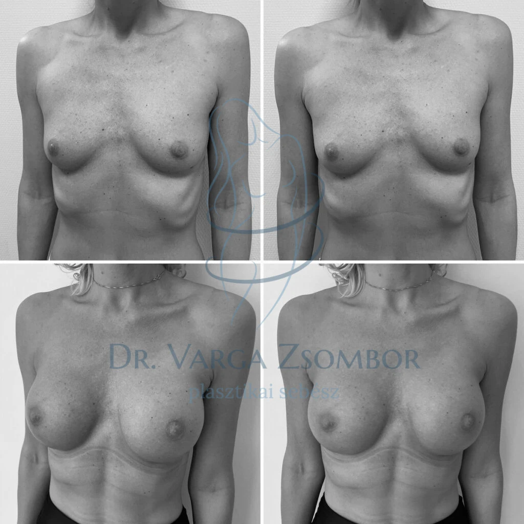 Testarányos mellnagyobbító műtét